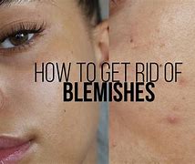 Image result for How to Get Rid of Skin Blemishes