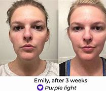 Image result for Before and After Brightening Face Mask