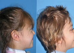 Image result for Crouzon Syndrome Treatment