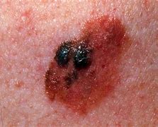 Image result for Brown Spot Skin Cancer On Face