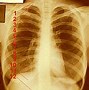 Image result for Female Rib Cage 5 and 6