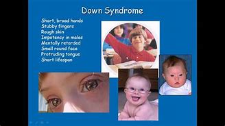 Image result for Trisomy 5 Syndrome