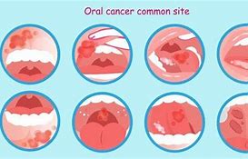 Image result for Stage 4 Oral Cancer