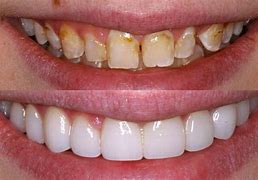 Image result for Cosmetic Dental Veneers