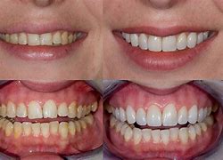 Image result for Cosmetic Dental Veneers