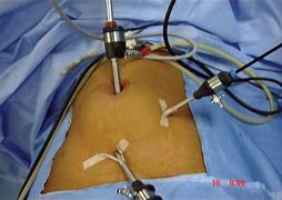 Image result for Lap Appy Surgical Sites