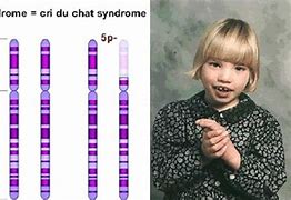 Image result for CRI Du Chat Disease