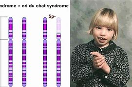 Image result for CRI Du Chat Syndrome