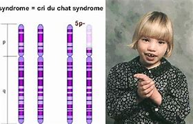 Image result for CRI Du Chat Larynx