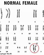 Image result for Turner Syndrome Chromosome