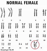 Image result for Karyotype of Turner's Syndrome