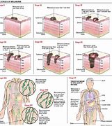 Image result for Stage 4 Metastatic Melanoma Weight Gain