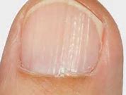 Image result for Vertical Ridges On Nails