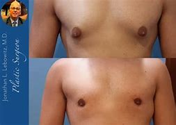 Image result for Male Gynecomastia