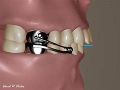 Image result for Herbst Appliance Orthodontics