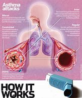 Image result for Asthma