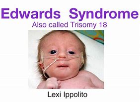 Image result for Edwards Syndrome Symptoms