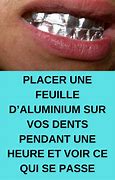 Image result for Blanchiment Des Dents