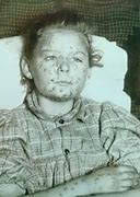 Image result for Photos of Smallpox