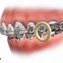 Image result for Invisalign with Rubber Bands