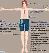Image result for Marfan's Syndrome Female