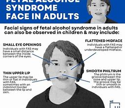 Image result for Fetal Alcohol Syndrome in Adults