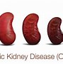 Image result for Kidney Disease Life Expectancy