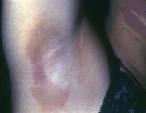 Acanthosis Nigricans   Pictures, Symptoms, Treatment and Causes