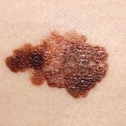 Image result for Stage 1A Melanoma