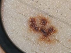 Image result for What Is Stage 4 Melanoma