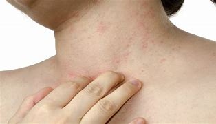 Image result for Smallpox Symptoms