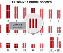Image result for Treatment of Trisomy 13 Syndrome