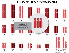 Image result for Trisomy 13 Life Expectancy