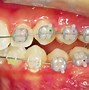 Image result for clear ceramic brackets