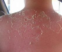 Image result for Blistering Sunburn