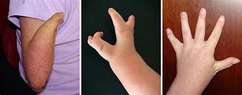 Image result for Cornelia De Lange Syndrome Hands