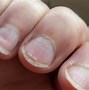 Image result for Fingernails Are Dented