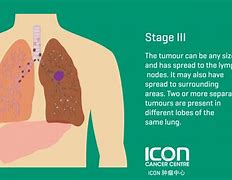 Image result for Stage Three Lung Cancer