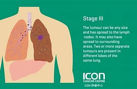 Image result for Terminal Stage 4 Lung Cancer