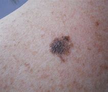 Image result for Early Stage Malignant Melanoma