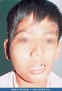 Image result for Epidermal Nevus Syndrome