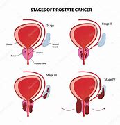 Image result for Stage 4 Prostate Cancer