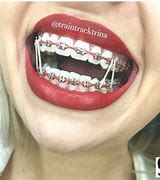 Image result for Colored Brackets for Braces