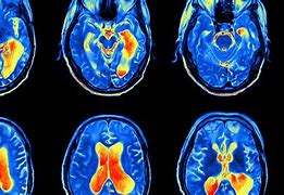 Image result for Stage 4 Brain Tumor