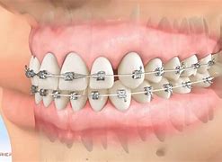 Image result for Carriere Appliance Orthodontics