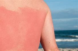 Image result for SunBurn Sunscreen