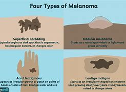Image result for Stage 5 Melanoma
