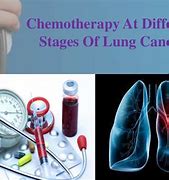 Image result for Lung Cancer Chemotherapy