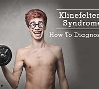 Image result for Physical Klinefelter Syndrome