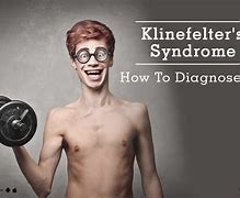 Image result for Klinefelter Syndrome Baby